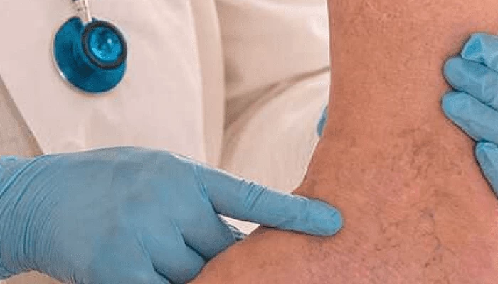 Лечение сосудистых звездочек